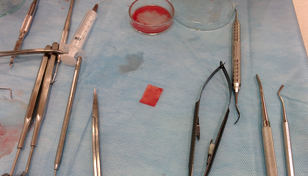 Narzędzia chirurgiczne i fragment tkanki do pogrubienia biotypu