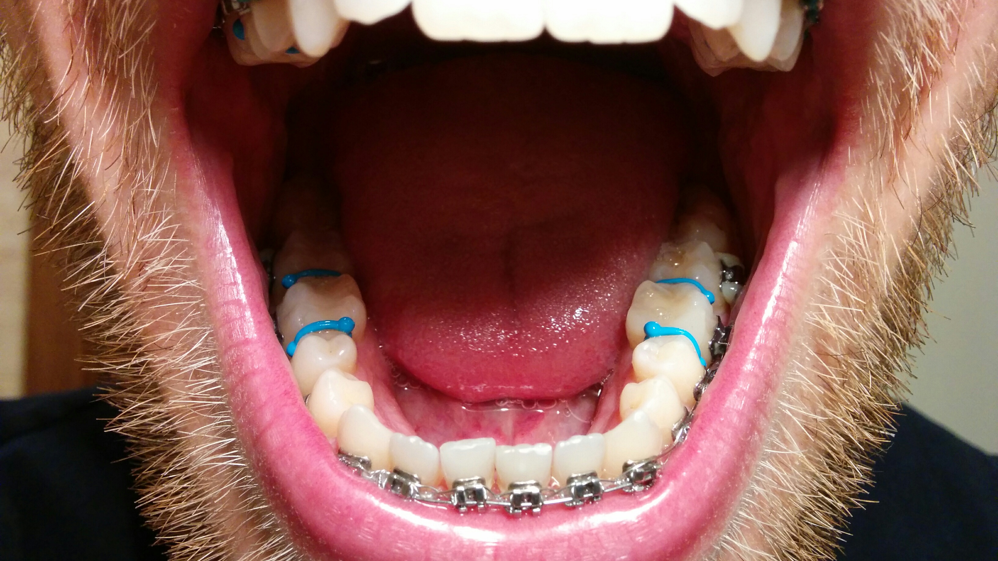 separacje ortodontyczne zadrutowani