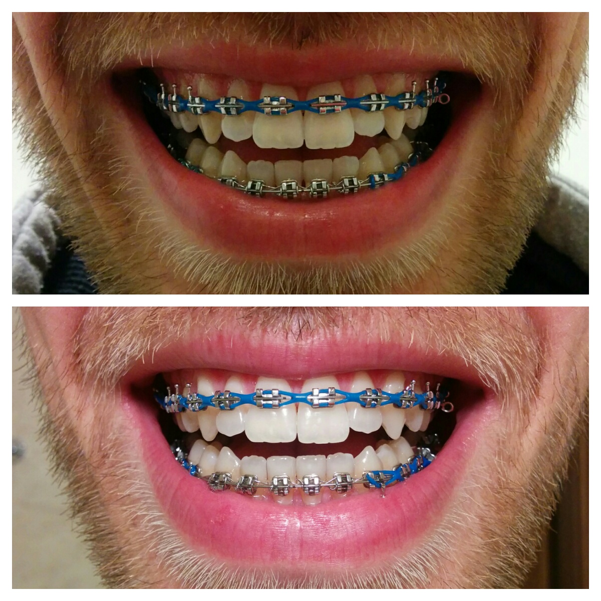 łańcuszek ortodontyczny przed i po wizycie zadrutowani