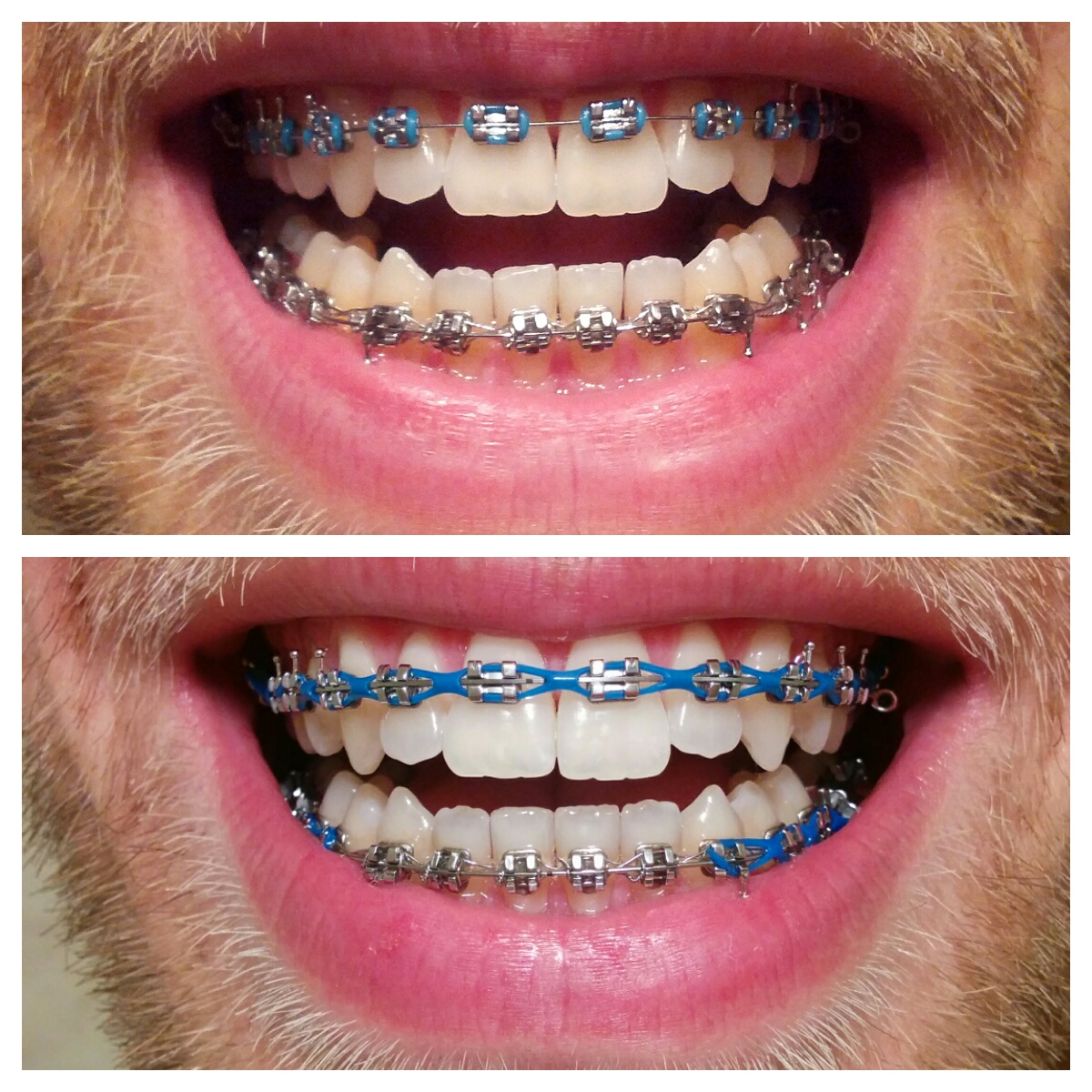 zdjęcie łańcuszka ortodontycznego przed i po wizycie