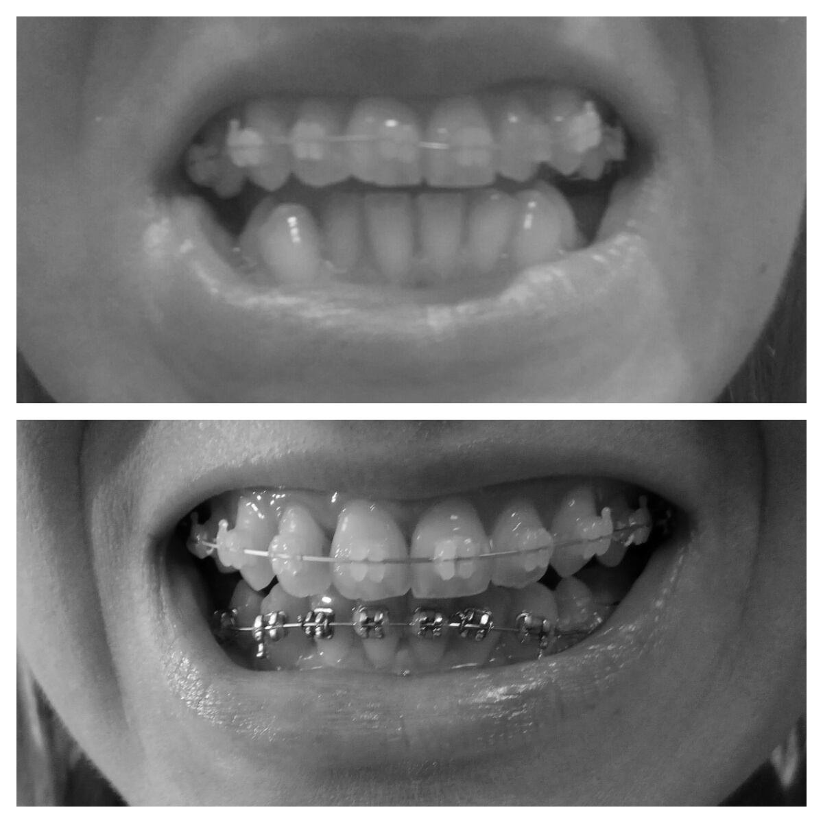 efekty leczenia ortodontycznego po 8 miesiącach dół zadrutowani