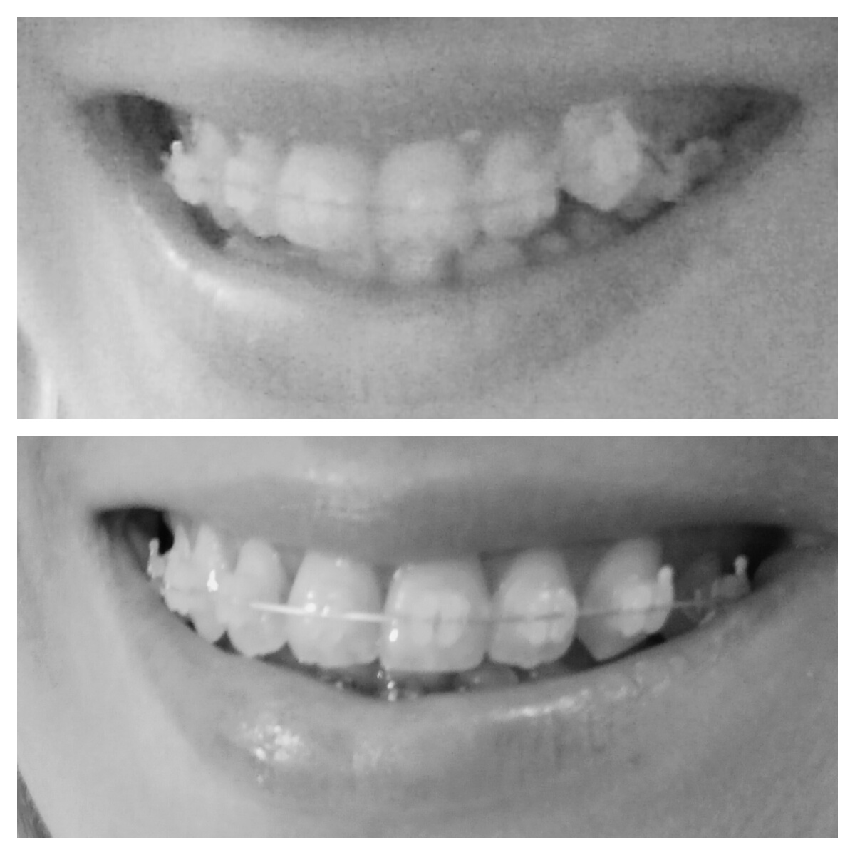 efekty leczenia ortodontycznego po 8 miesiącach profil zadrutowani