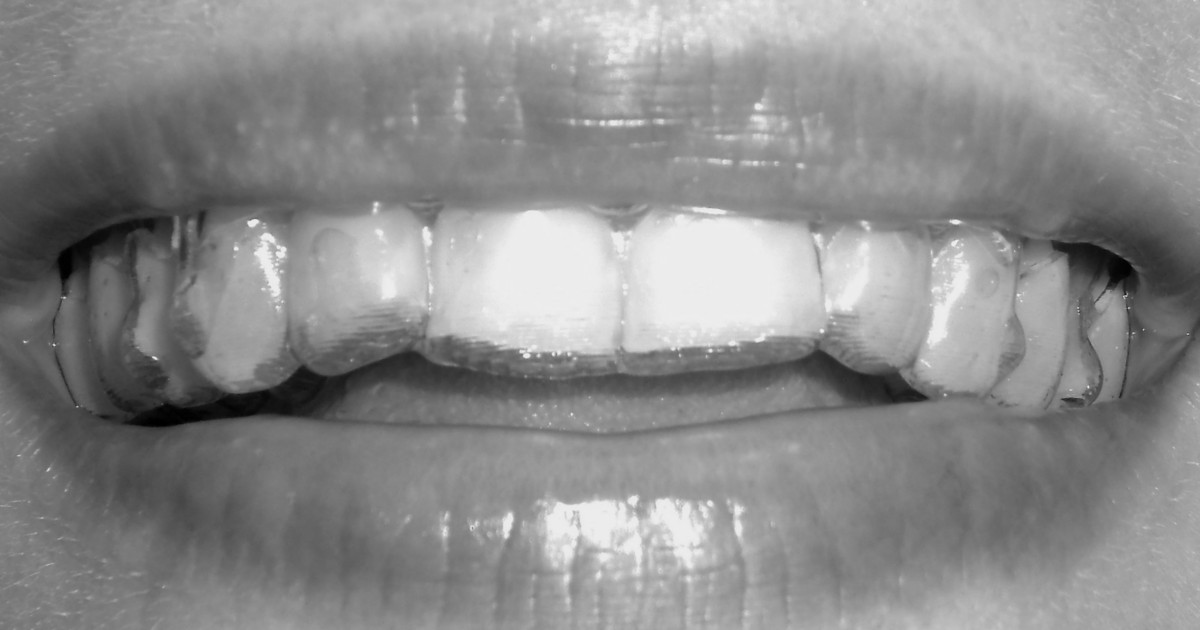 Aparat Invisalign