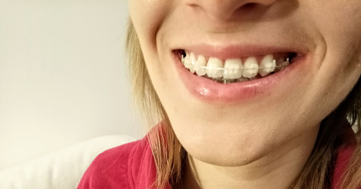 Efekty leczenia ortodontycznego po 8 miesiącach