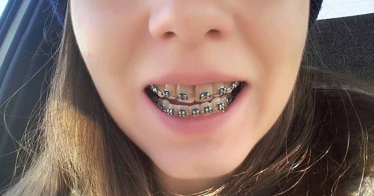 Martwe zęby a aparat ortodontyczny – historia Moniki