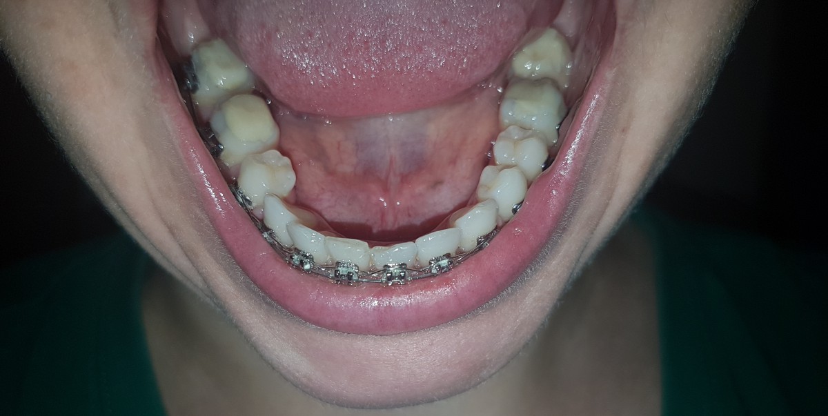 Bajty na tylnych zębach
